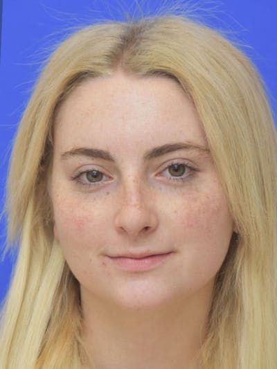 Rhinoplasty Before & After Gallery - Patient 113586 - Image 2