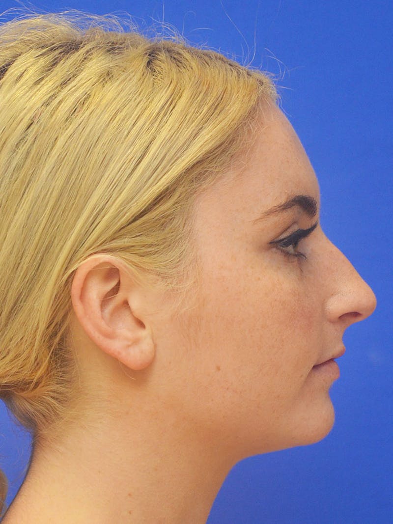 Rhinoplasty Before & After Gallery - Patient 113586 - Image 3