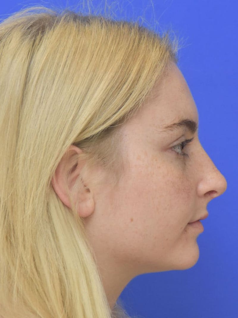 Rhinoplasty Before & After Gallery - Patient 113586 - Image 4