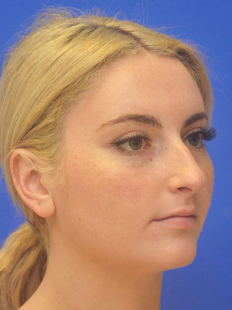 Rhinoplasty Before & After Gallery - Patient 113586 - Image 5