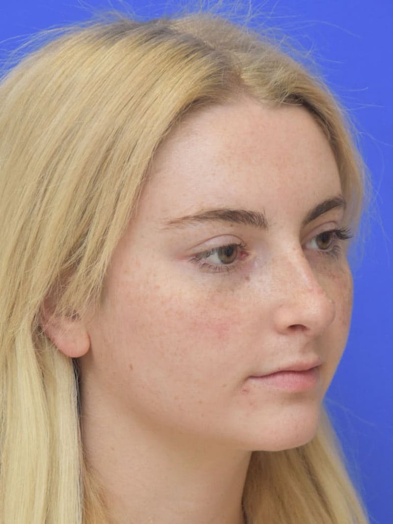 Rhinoplasty Before & After Gallery - Patient 113586 - Image 6