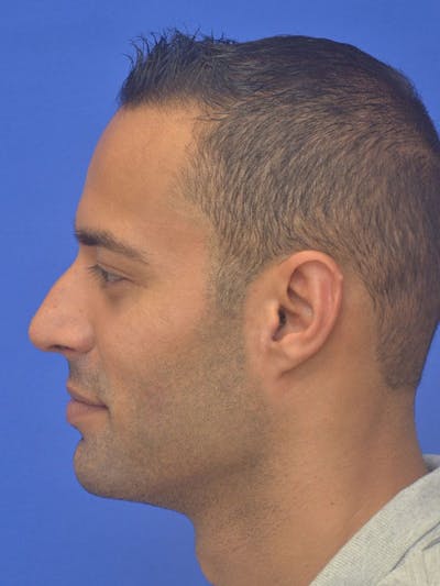 Rhinoplasty Before & After Gallery - Patient 415994 - Image 1