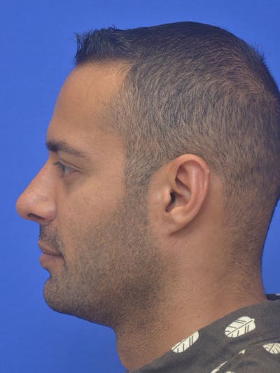 Rhinoplasty Before & After Gallery - Patient 415994 - Image 2
