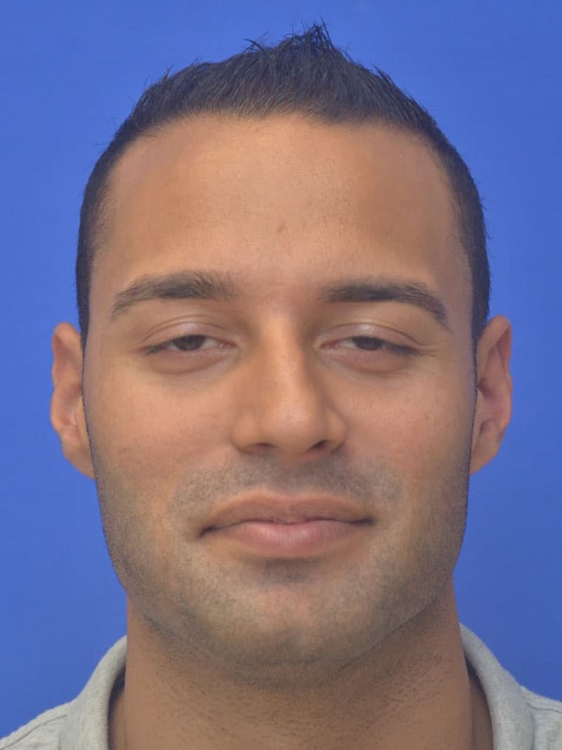 Rhinoplasty Before & After Gallery - Patient 415994 - Image 3