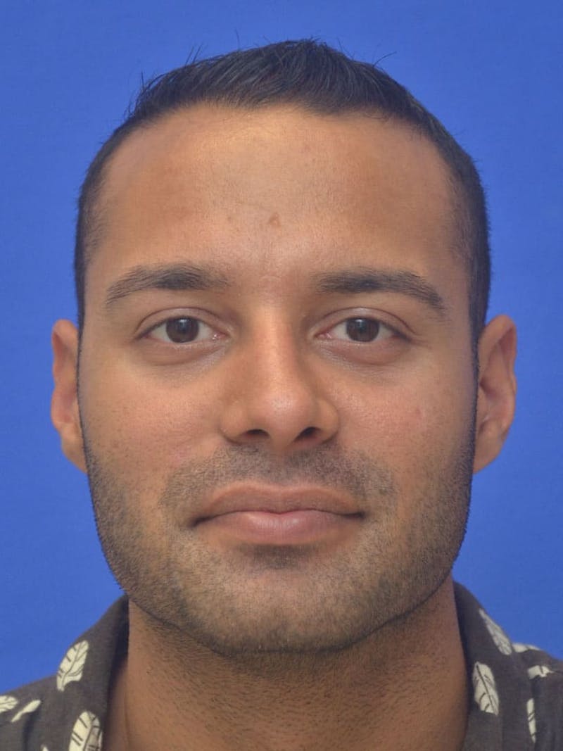 Rhinoplasty Before & After Gallery - Patient 415994 - Image 4