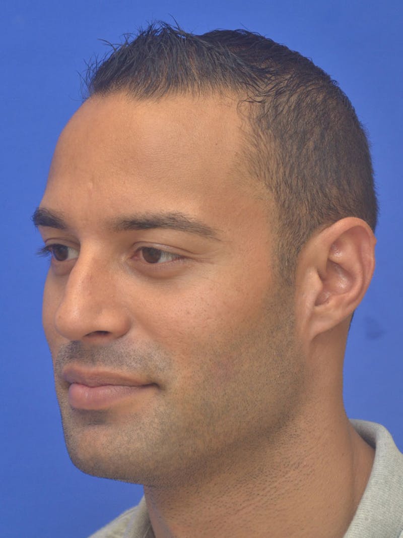 Rhinoplasty Before & After Gallery - Patient 415994 - Image 5