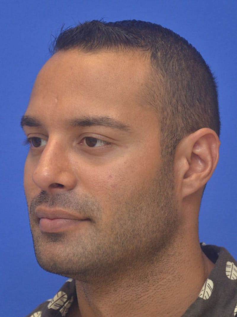 Rhinoplasty Before & After Gallery - Patient 415994 - Image 6
