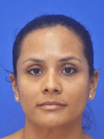 Rhinoplasty Before & After Gallery - Patient 310744 - Image 1
