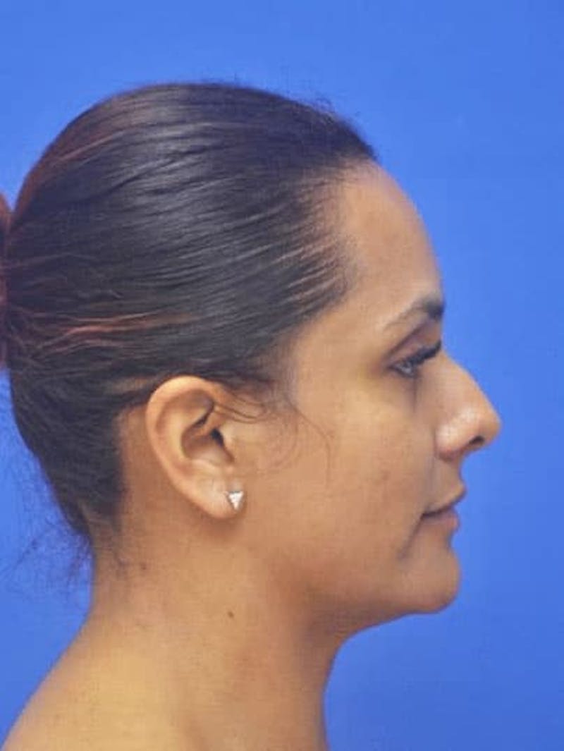 Rhinoplasty Before & After Gallery - Patient 310744 - Image 3