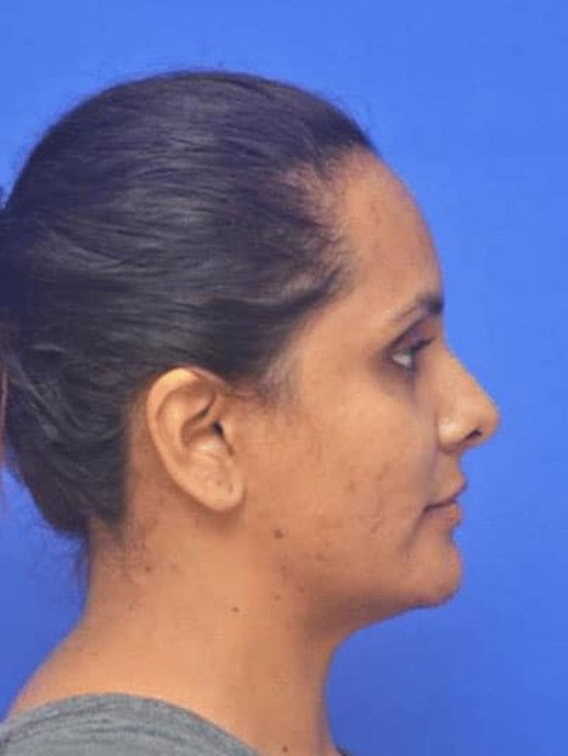 Rhinoplasty Before & After Gallery - Patient 310744 - Image 4
