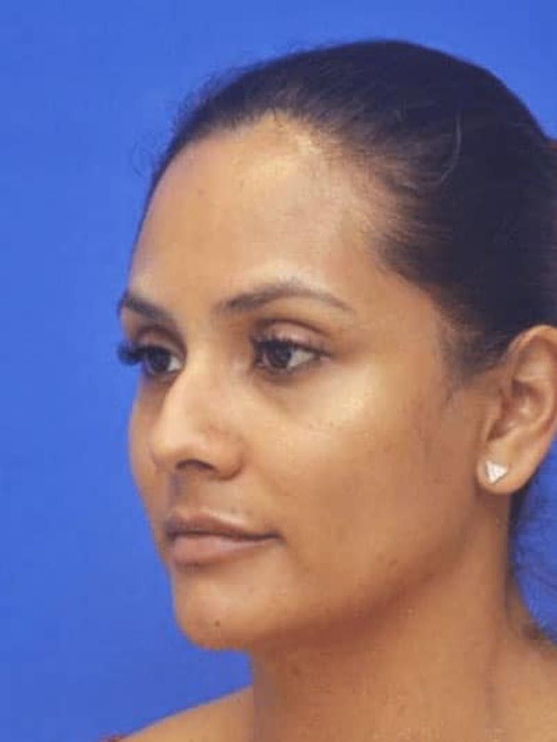 Rhinoplasty Before & After Gallery - Patient 310744 - Image 5