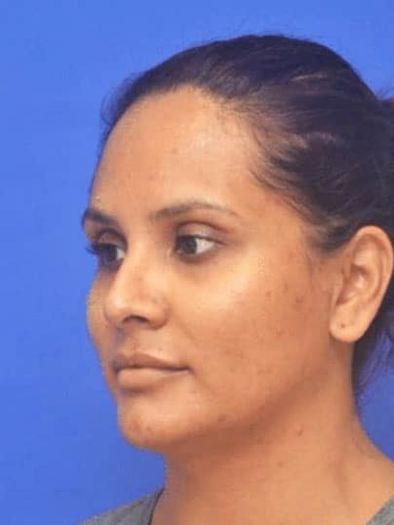 Rhinoplasty Before & After Gallery - Patient 310744 - Image 6