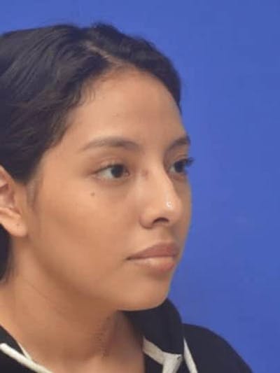 Rhinoplasty Before & After Gallery - Patient 290846 - Image 1