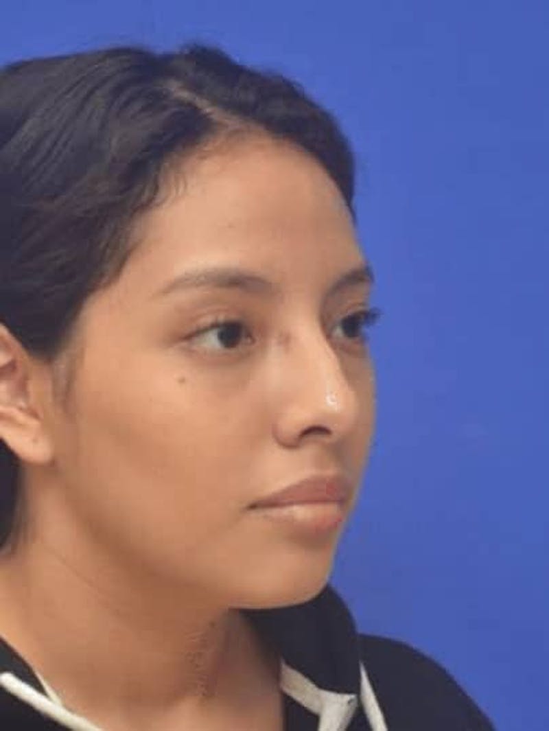 Rhinoplasty Before & After Gallery - Patient 290846 - Image 1