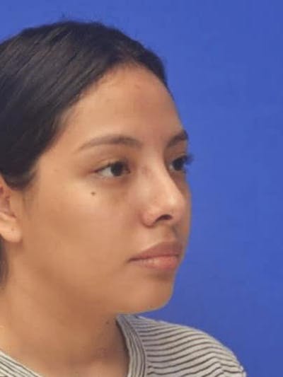 Rhinoplasty Before & After Gallery - Patient 290846 - Image 2