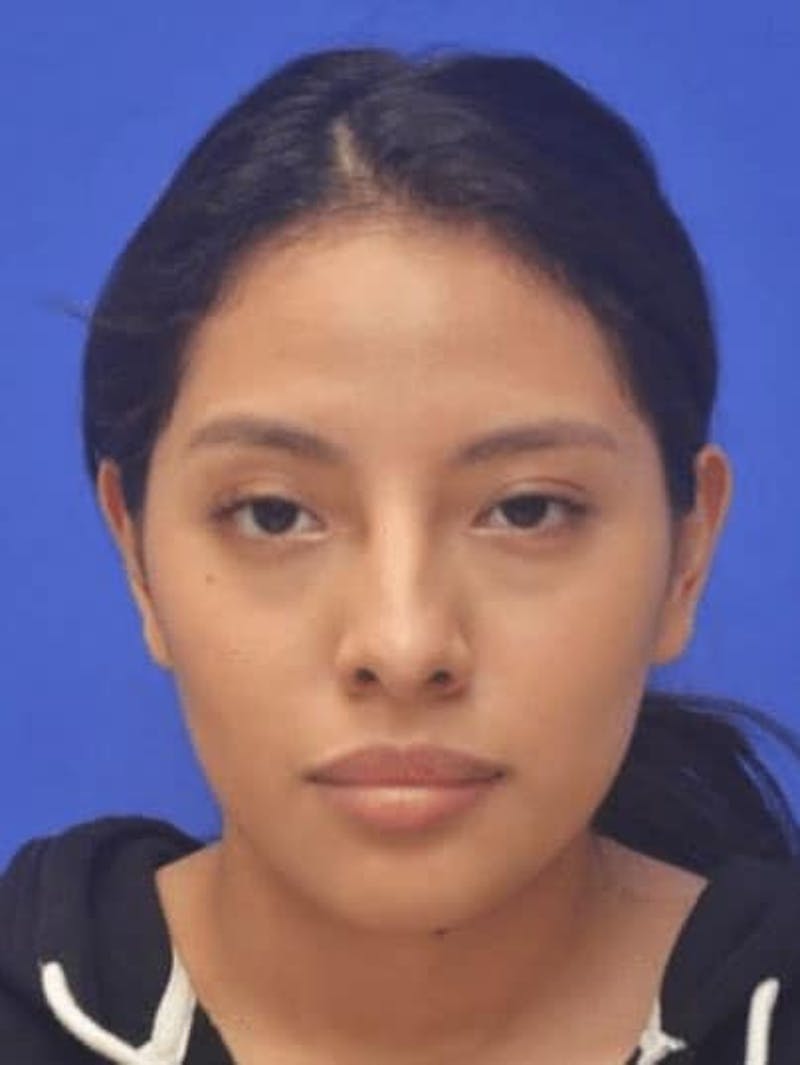 Rhinoplasty Before & After Gallery - Patient 290846 - Image 3