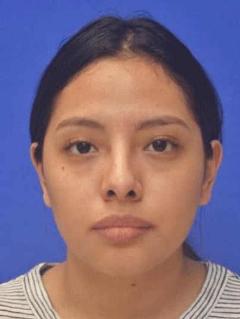 Rhinoplasty Before & After Gallery - Patient 290846 - Image 4