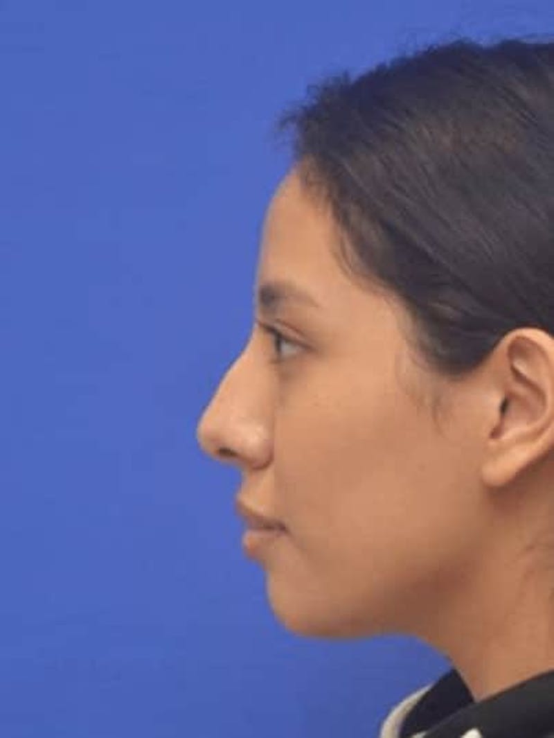 Rhinoplasty Before & After Gallery - Patient 290846 - Image 5
