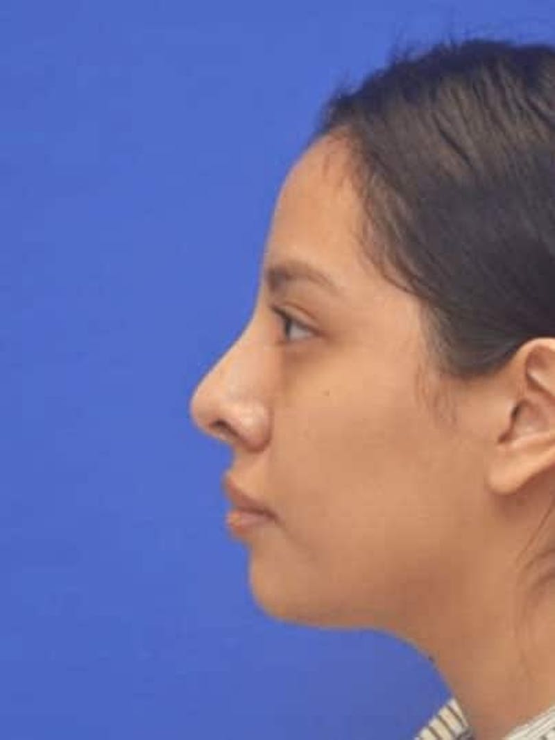 Rhinoplasty Before & After Gallery - Patient 290846 - Image 6