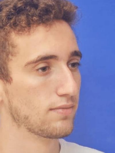 Rhinoplasty Before & After Gallery - Patient 308492 - Image 1