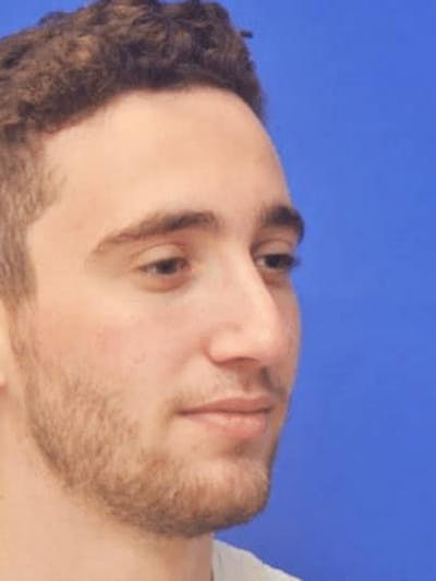 Rhinoplasty Before & After Gallery - Patient 308492 - Image 2