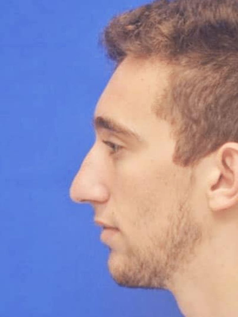 Rhinoplasty Before & After Gallery - Patient 308492 - Image 5