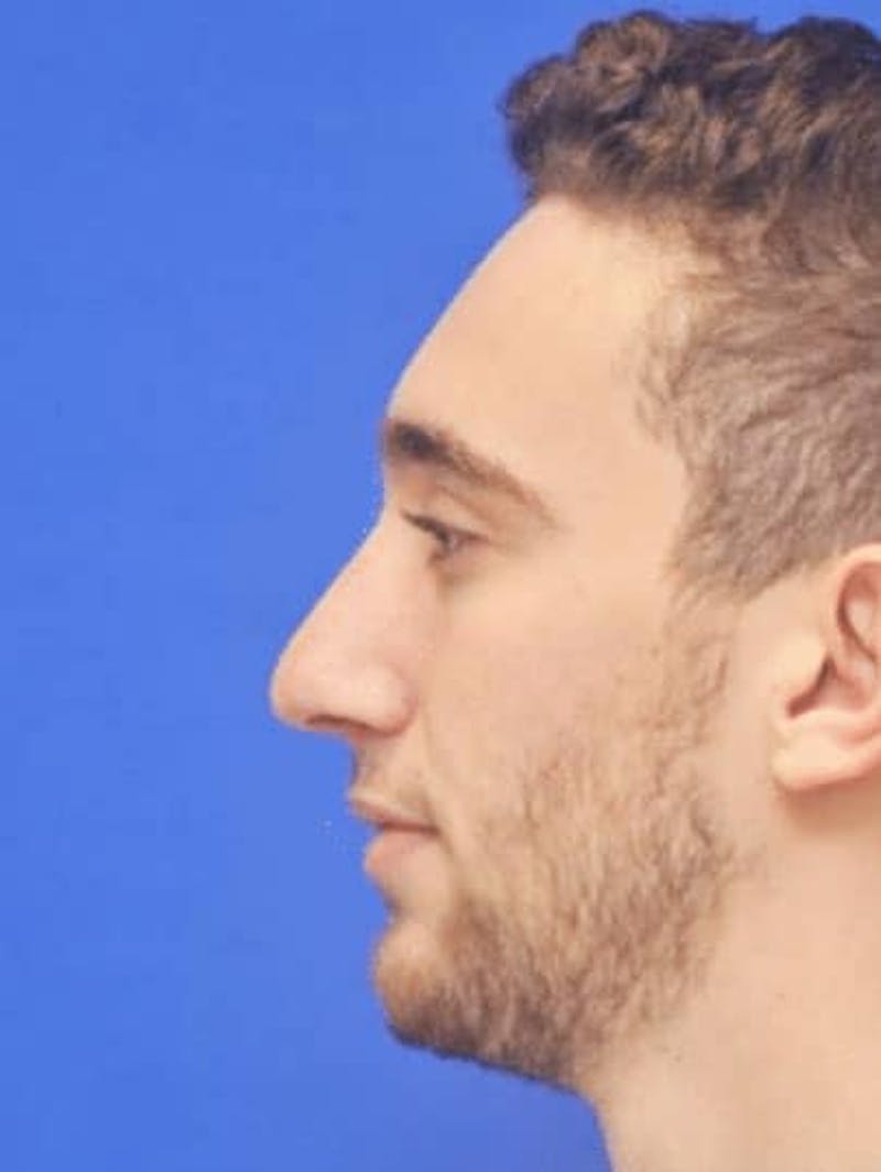Rhinoplasty Before & After Gallery - Patient 308492 - Image 6