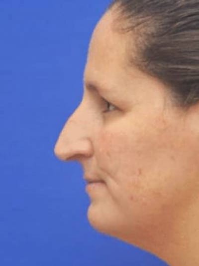 Rhinoplasty Before & After Gallery - Patient 117253 - Image 1