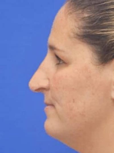 Rhinoplasty Before & After Gallery - Patient 117253 - Image 2