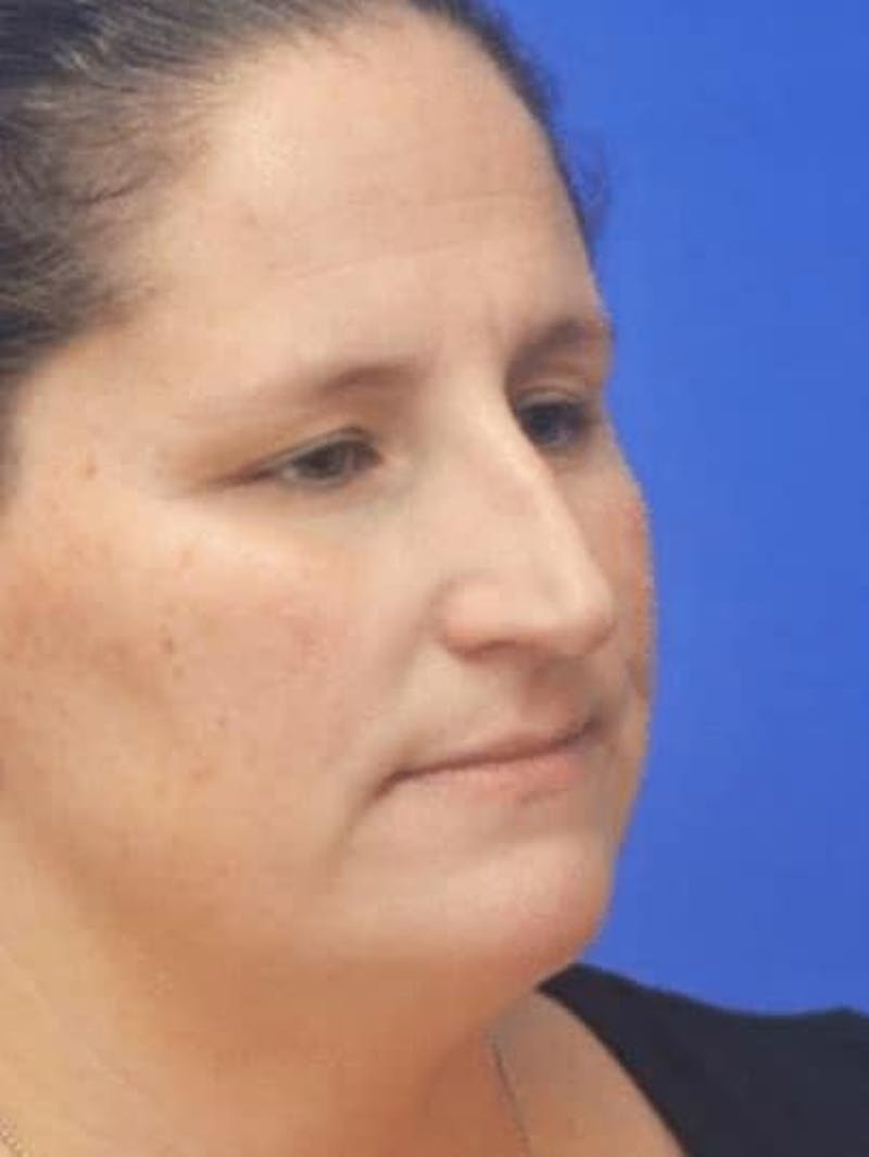 Rhinoplasty Before & After Gallery - Patient 117253 - Image 3