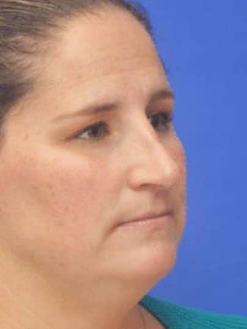 Rhinoplasty Before & After Gallery - Patient 117253 - Image 4