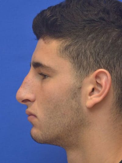 Rhinoplasty Before & After Gallery - Patient 407024 - Image 1