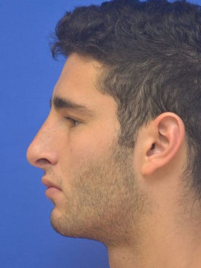 Rhinoplasty Before & After Gallery - Patient 407024 - Image 2