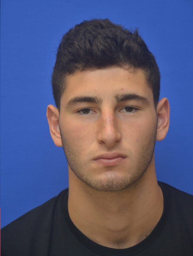 Rhinoplasty Before & After Gallery - Patient 407024 - Image 3