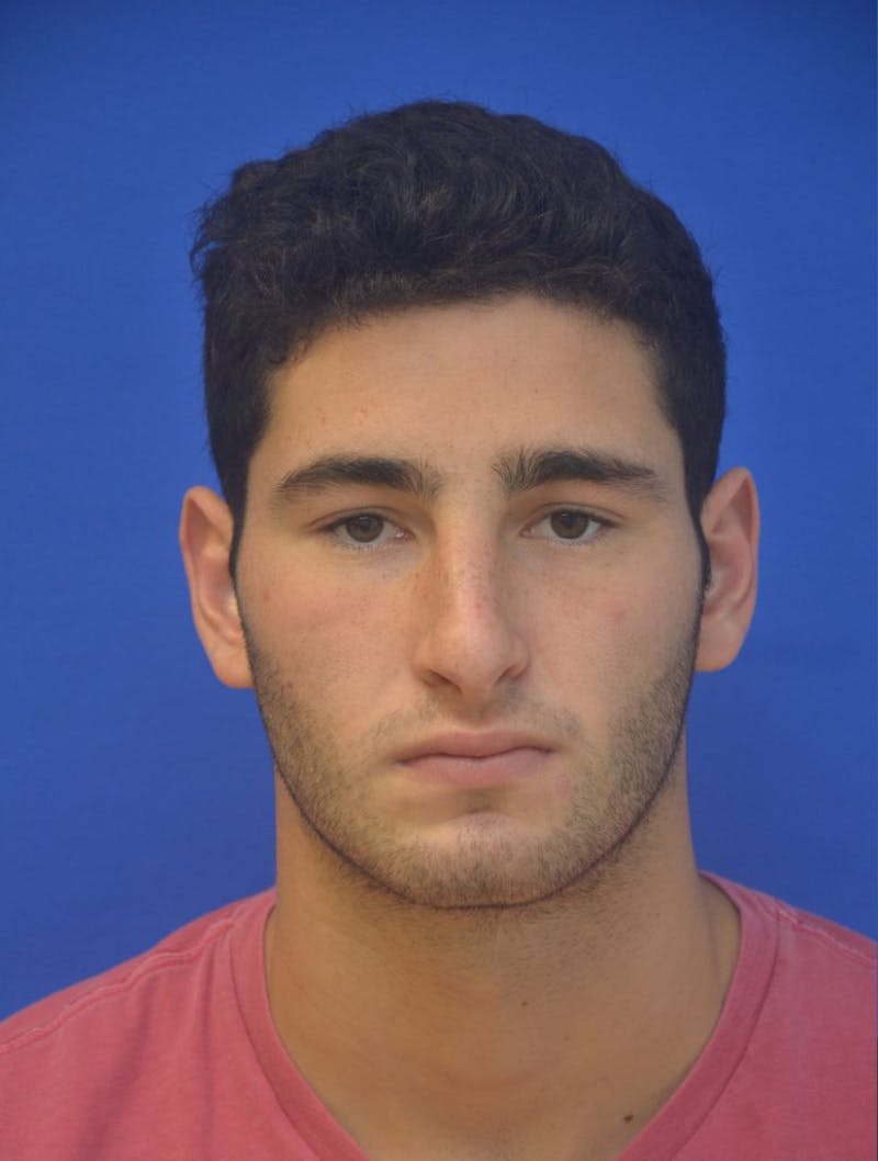 Rhinoplasty Before & After Gallery - Patient 407024 - Image 4