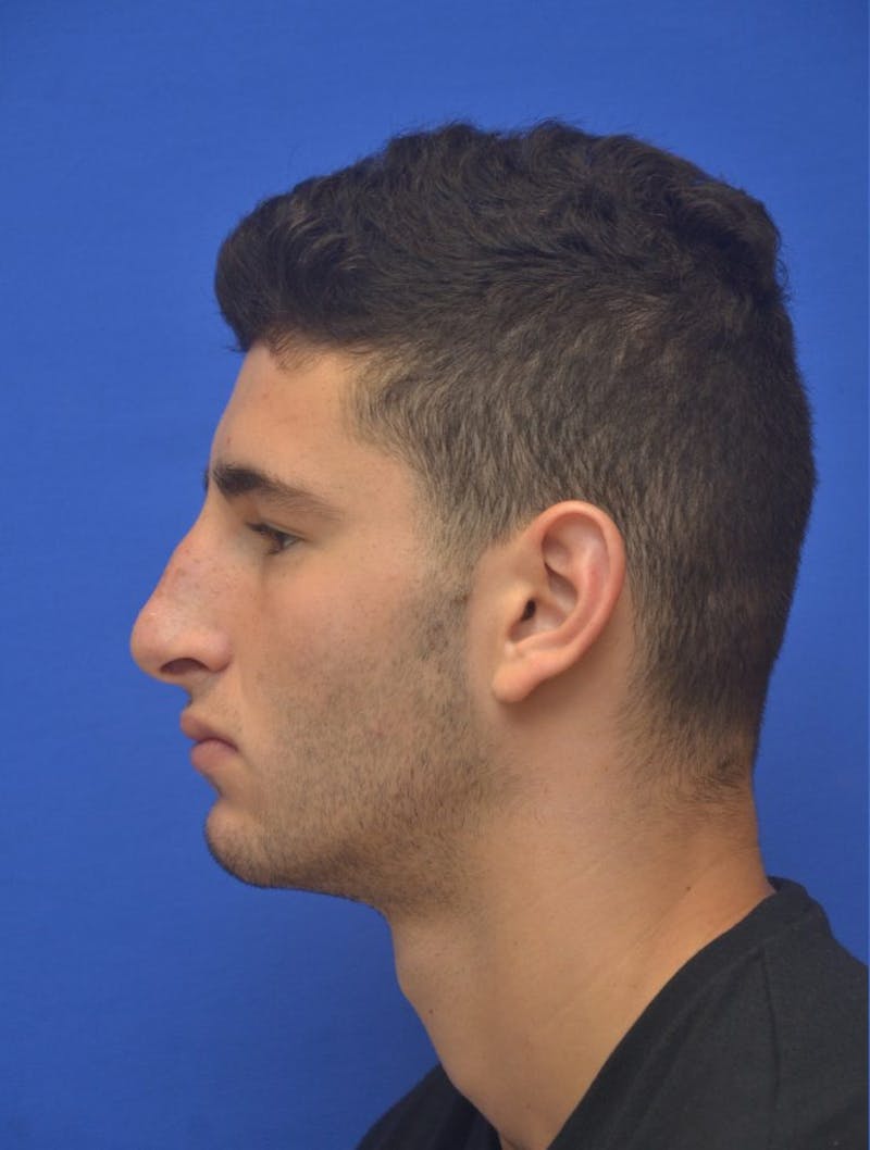 Rhinoplasty Before & After Gallery - Patient 407024 - Image 5