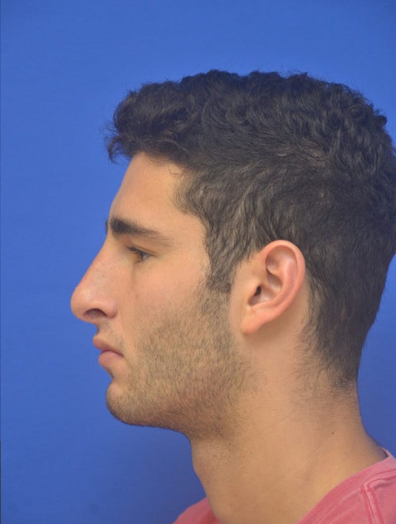 Rhinoplasty Before & After Gallery - Patient 407024 - Image 6