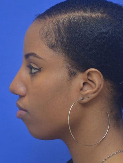 Rhinoplasty Before & After Gallery - Patient 300949 - Image 1