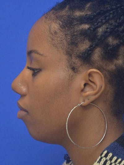 Rhinoplasty Before & After Gallery - Patient 300949 - Image 2