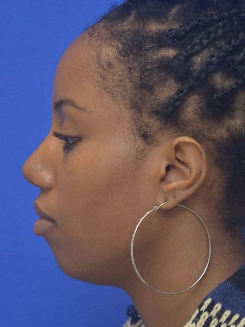 Rhinoplasty Before & After Gallery - Patient 300949 - Image 2