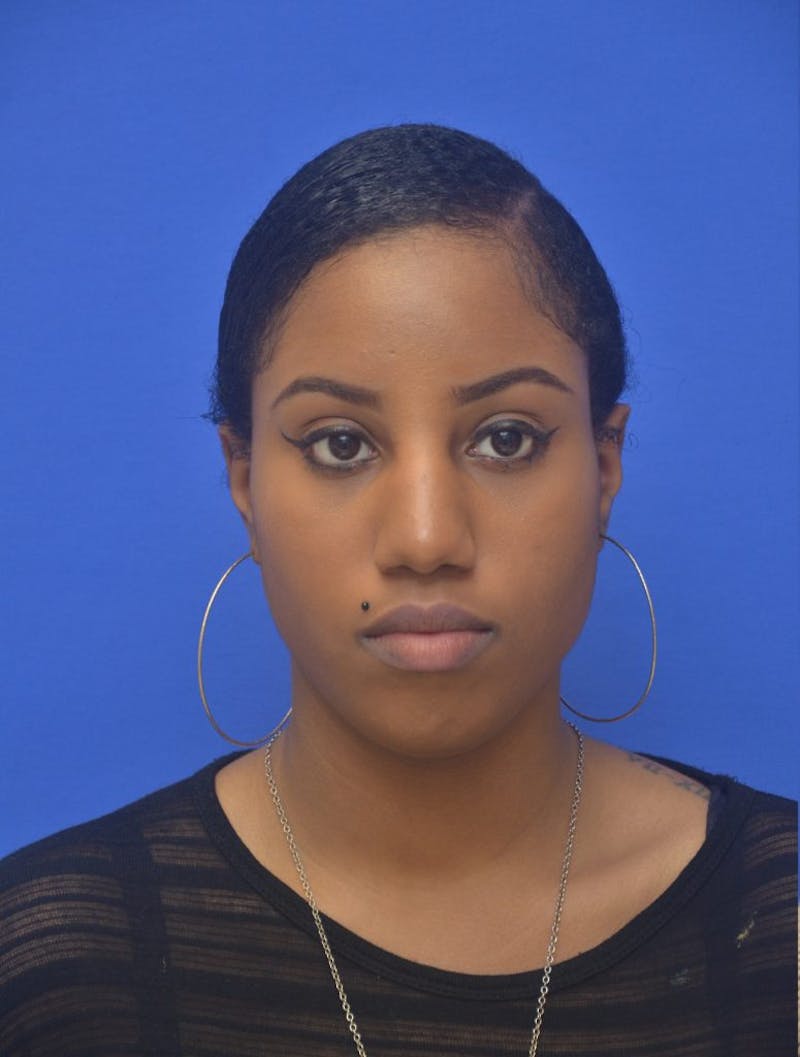 Rhinoplasty Before & After Gallery - Patient 300949 - Image 3