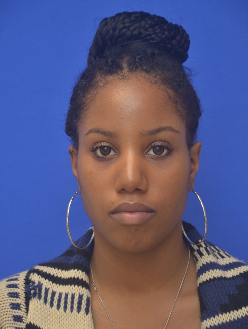 Rhinoplasty Before & After Gallery - Patient 300949 - Image 4