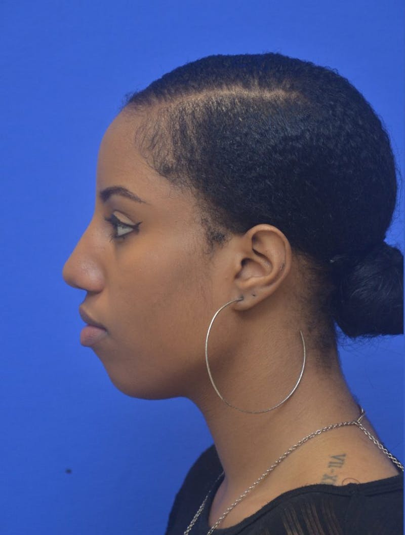 Rhinoplasty Before & After Gallery - Patient 300949 - Image 5