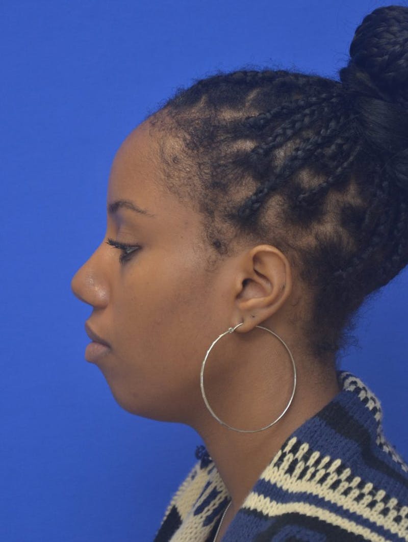 Rhinoplasty Before & After Gallery - Patient 300949 - Image 6
