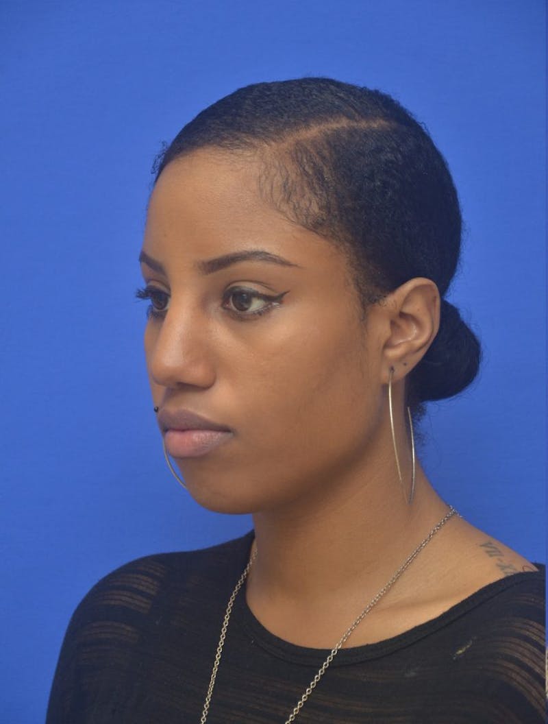 Rhinoplasty Before & After Gallery - Patient 300949 - Image 7