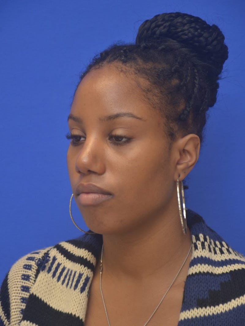 Rhinoplasty Before & After Gallery - Patient 300949 - Image 8