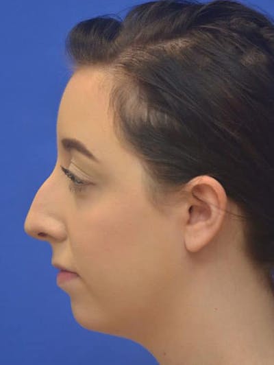 Rhinoplasty Before & After Gallery - Patient 298784 - Image 1