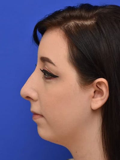 Rhinoplasty Before & After Gallery - Patient 298784 - Image 2