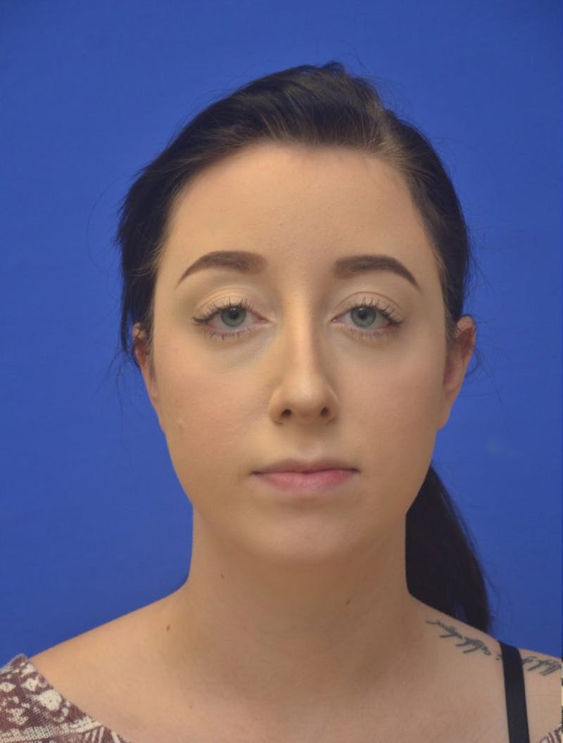 Rhinoplasty Before & After Gallery - Patient 298784 - Image 3