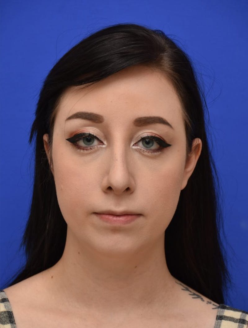 Rhinoplasty Before & After Gallery - Patient 298784 - Image 4